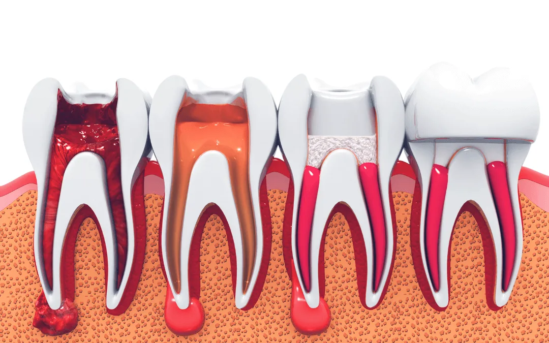 Leczenie kanałowe Radom